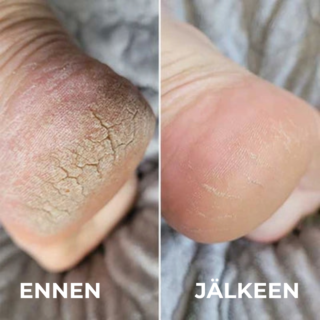 Ammattilaisen kovettumienpoistaja